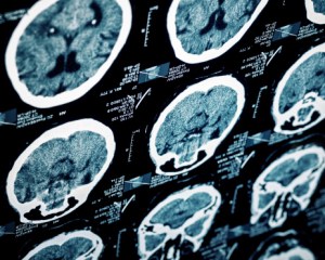 Brain Injuries Caused by Medical Malpractice