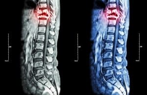 Failure to Diagnose and Misdiagnoses of a Spinal Cord Abscess
