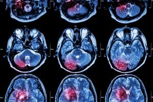What Kinds of Brain Injuries Are Caused by Medical Malpractice?
