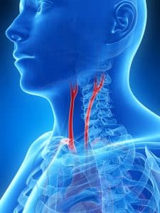 Can a massage cause someone to suffer a carotid artery dissection? Find out from our Washington DC personal injury attorneys.